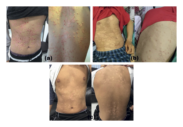 G-MSC輸注對一名有5年嚴(yán)重斑塊狀銀屑病病史的19歲男性的影響。 G-MSC輸注對一名有5年嚴(yán)重斑塊狀銀屑病病史的19歲男性的影響。