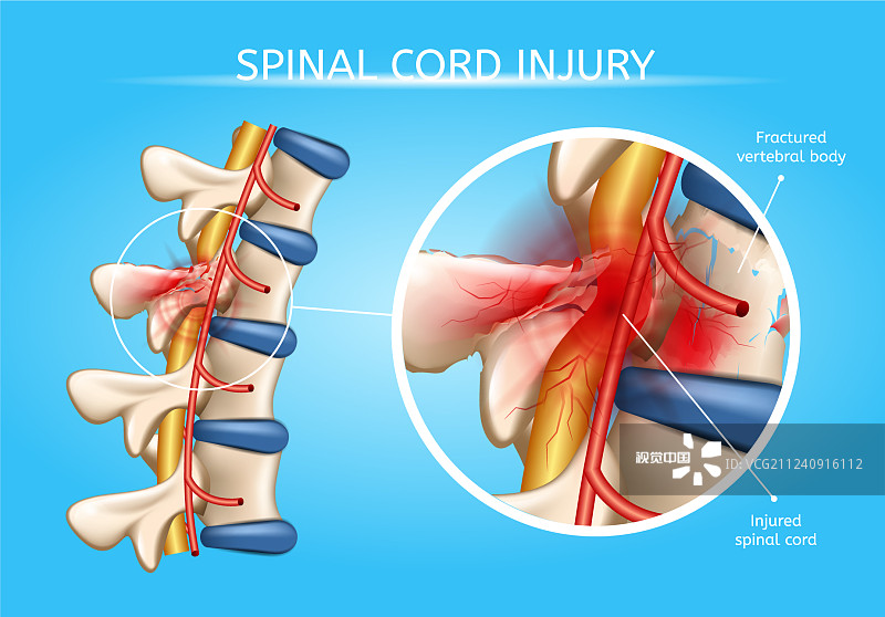 神經(jīng)干細(xì)胞移植在脊髓損傷修復(fù)中的作用及應(yīng)用 神經(jīng)干細(xì)胞移植在脊髓損傷修復(fù)中的作用及應(yīng)用
