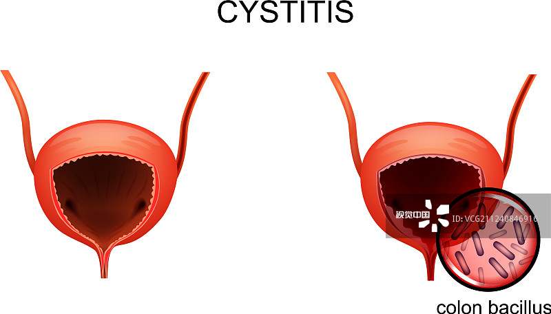 韓國首爾醫院公布:干細胞治療間質性膀胱炎的I期研究結果 韓國首爾醫院公布:干細胞治療間質性膀胱炎的I期研究結果