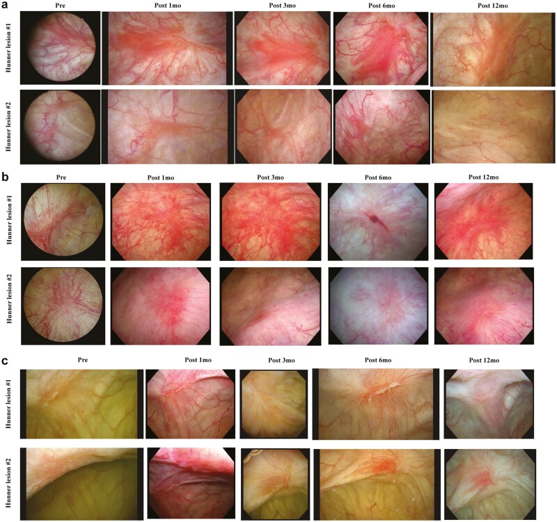 圖1:每位患者Hunner病變的連續膀胱鏡圖像。 圖1:每位患者Hunner病變的連續膀胱鏡圖像。