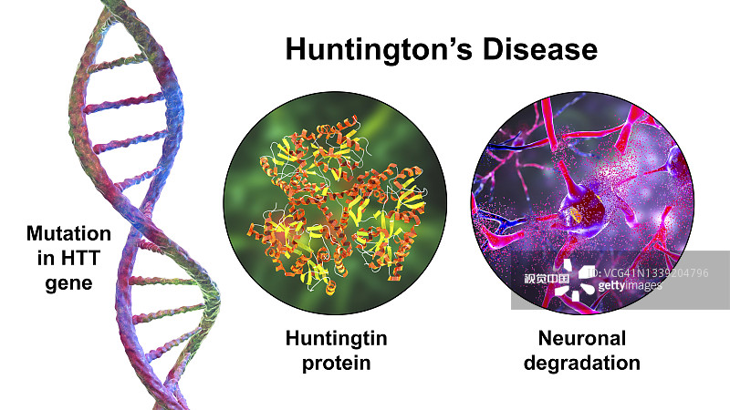 亨廷頓氏病,概念性說明 亨廷頓氏病,概念性說明