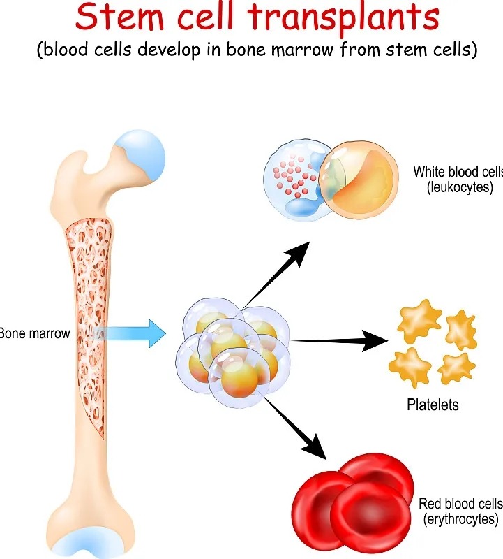 干細胞移植手術(shù) 干細胞移植手術(shù)