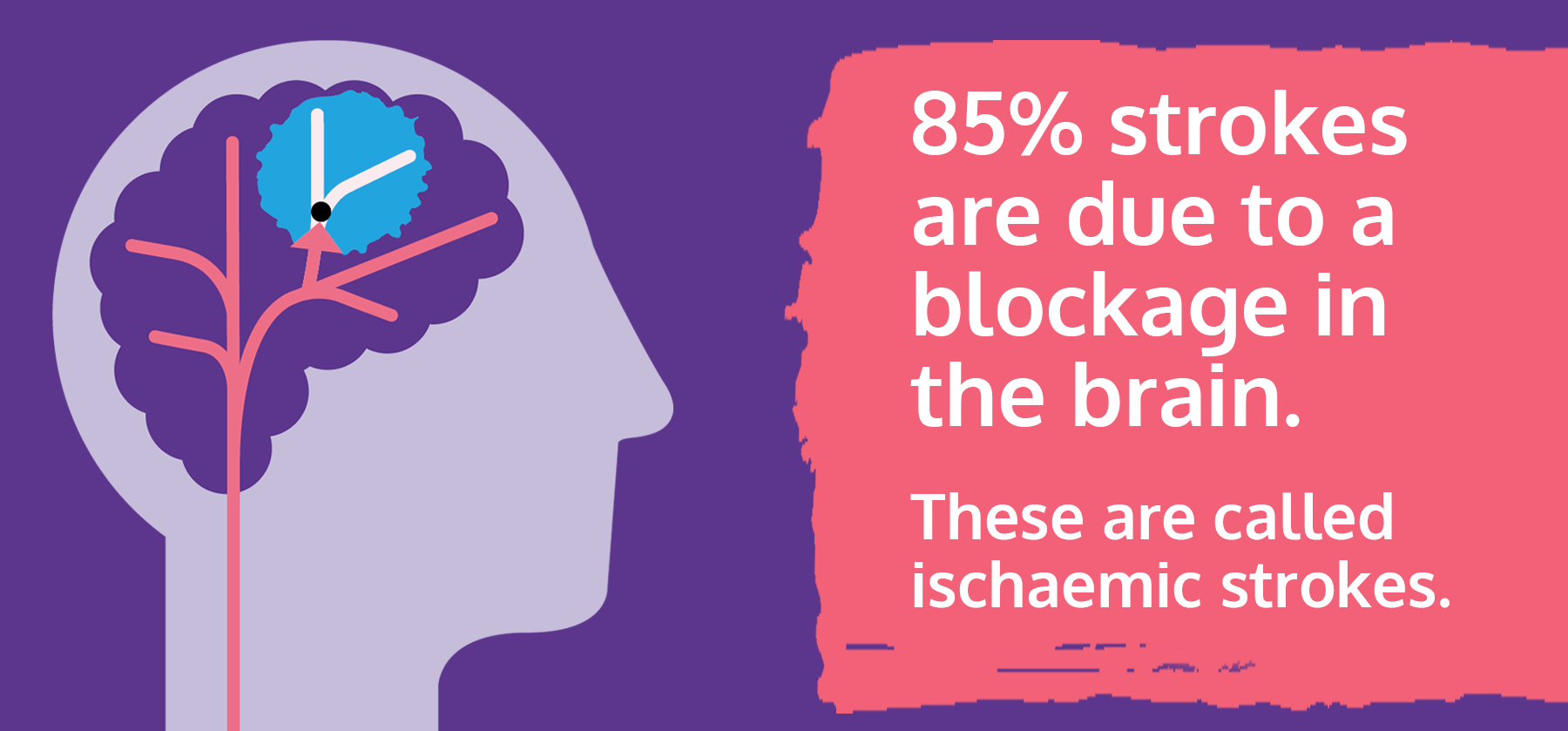 什么是缺血性中風