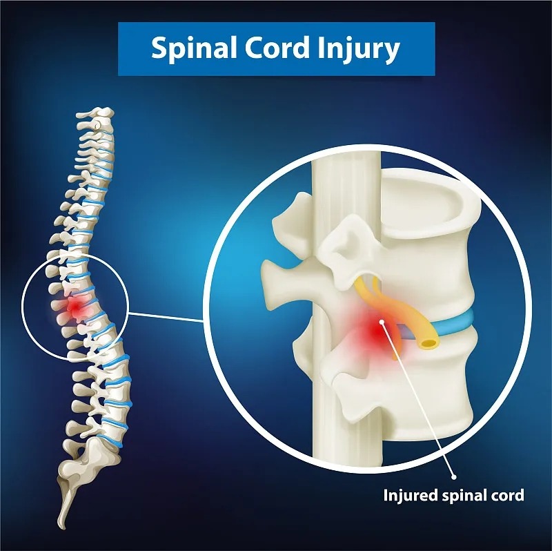 國家神經疾病研究所:脊髓損傷的詳細信息