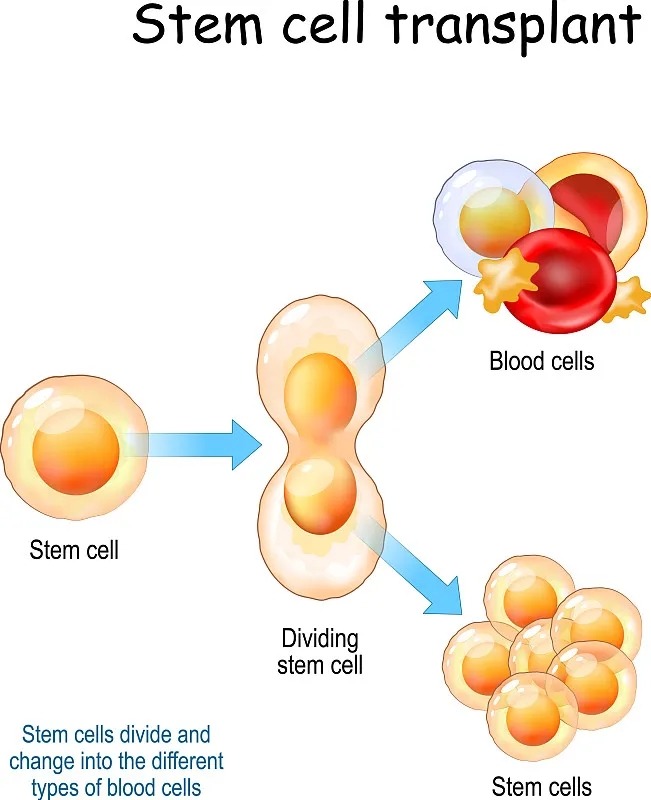 干細(xì)胞移植的五個(gè)階段是什么 干細(xì)胞移植的流程分為那五個(gè)階段