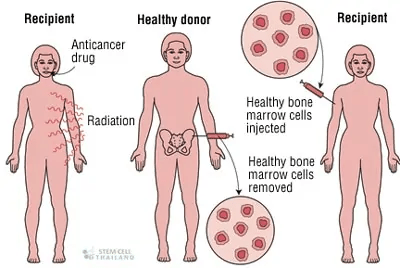 什么是造血干細胞和造血干細胞移植 什么是造血干細胞和造血干細胞移植