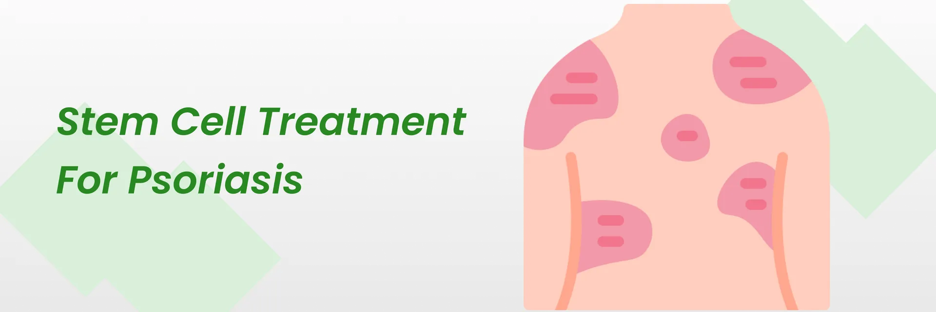 干細胞治療銀屑病2023(銀屑病患者的新希望) 干細胞治療銀屑病2024(銀屑病患者的新希望)