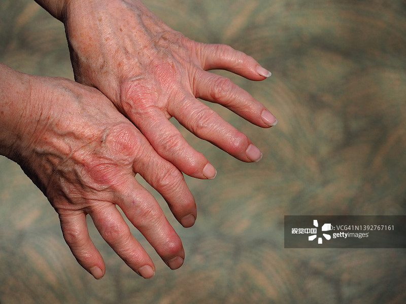 研究為治療類風濕性關節炎開辟了新的治療途徑 研究為治療類風濕性關節炎開辟了新的治療途徑