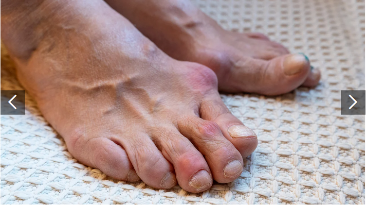 類風濕關節炎癥狀