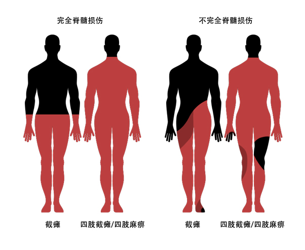 脊髓損傷并發(fā)癥 脊髓損傷并發(fā)癥