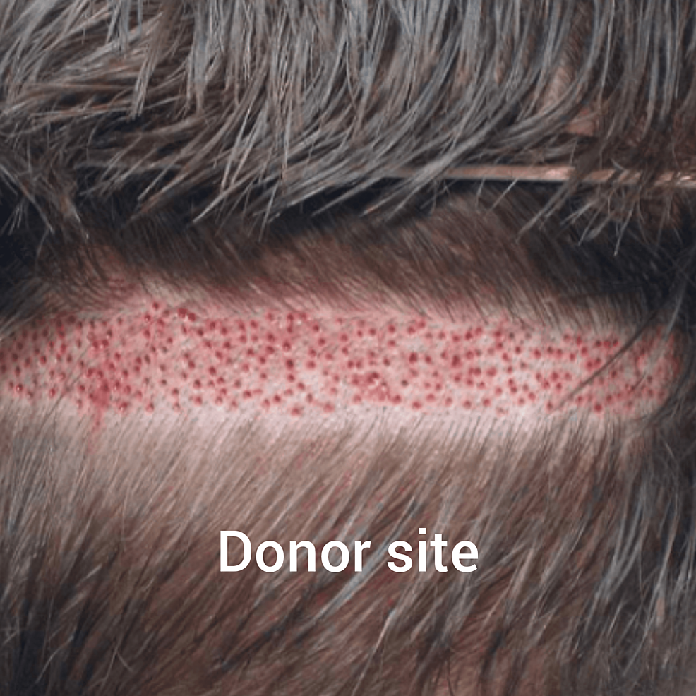新技術的供體現場收獲試圖減少后部頭皮疤痕