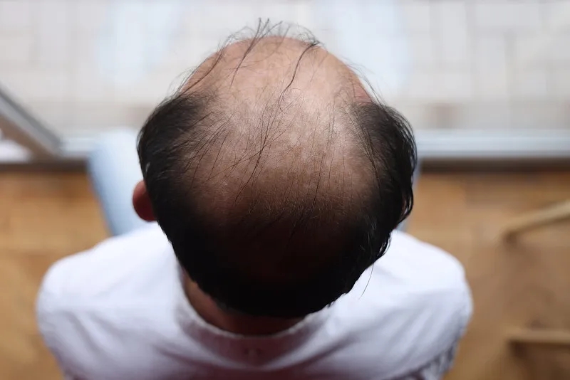 干細胞治療脫發(fā)的優(yōu)缺點