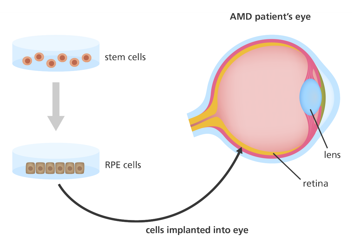 插圖顯示干細胞如何用于產生可用于治療年齡相關性黃斑變性 (AMD) 患者的視網膜色素上皮 (RPE) 細胞 插圖顯示干細胞如何用于產生可用于治療年齡相關性黃斑變性 (AMD) 患者的視網膜色素上皮 (RPE) 細胞