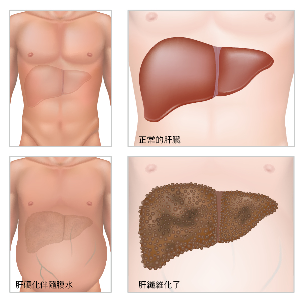 干細胞移植作為中國人群肝硬化的輔助治療策略-:有效性和安全性的薈萃分析 干細胞移植作為中國人群肝硬化的輔助治療策略-:有效性和安全性的薈萃分析