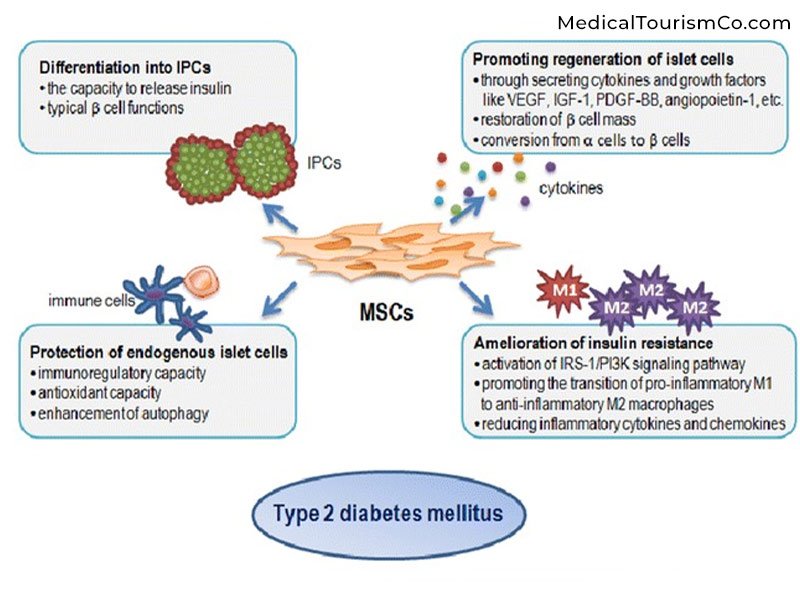 為什么干細胞治療2型糖尿病？