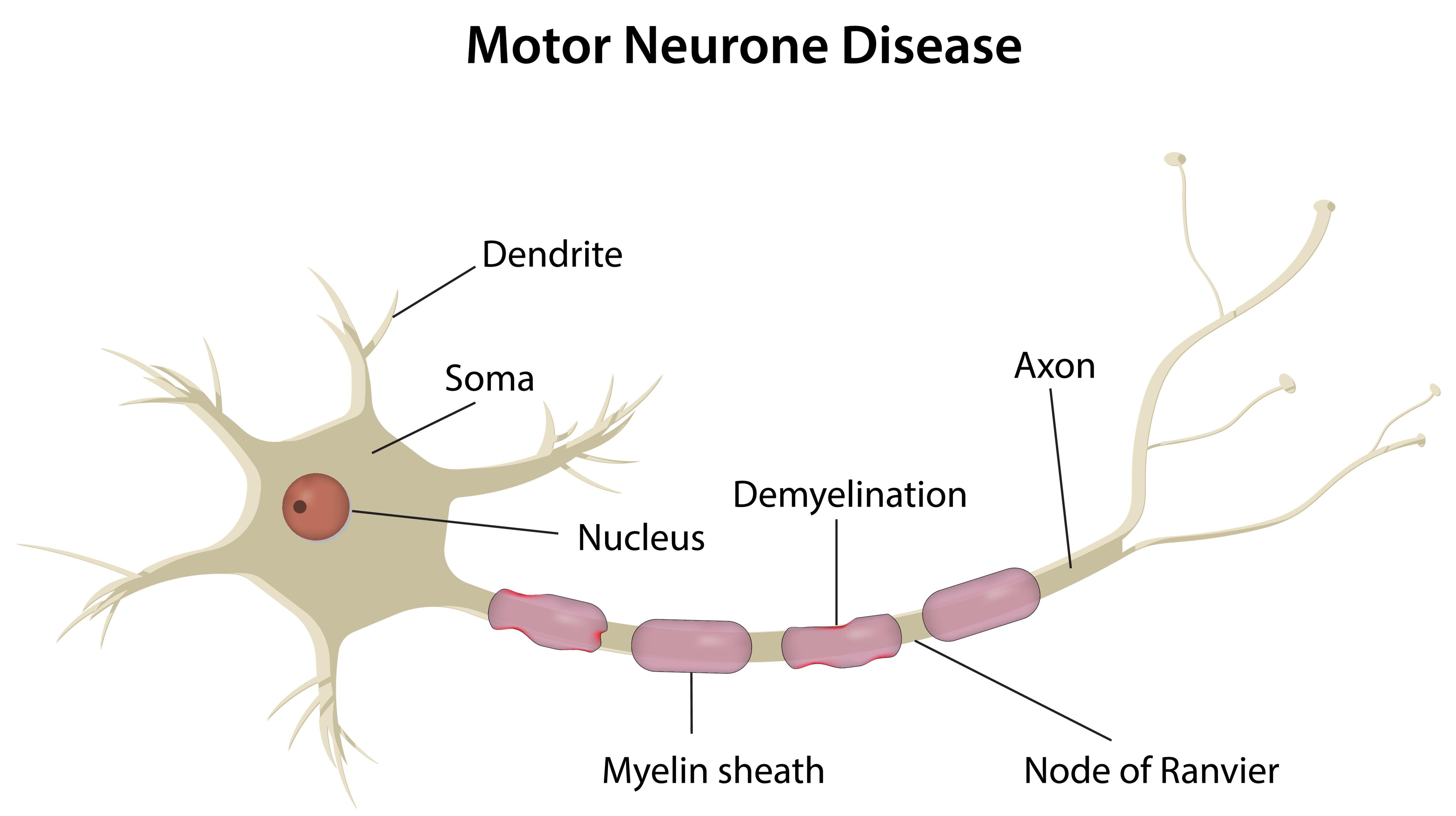 什么是運動神經元病？