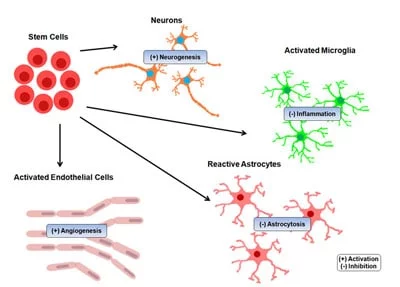 干細(xì)胞治療中風(fēng)的結(jié)果 干細(xì)胞治療中風(fēng)的結(jié)果