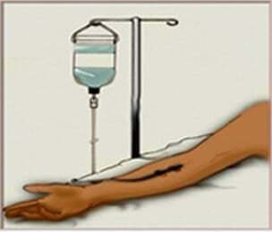 靜脈注射圖像。