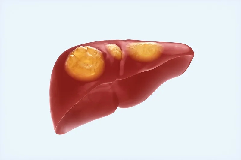 什么是脂肪肝 什么是脂肪肝