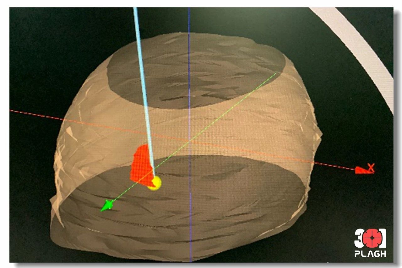 術前定路徑 術前定路徑