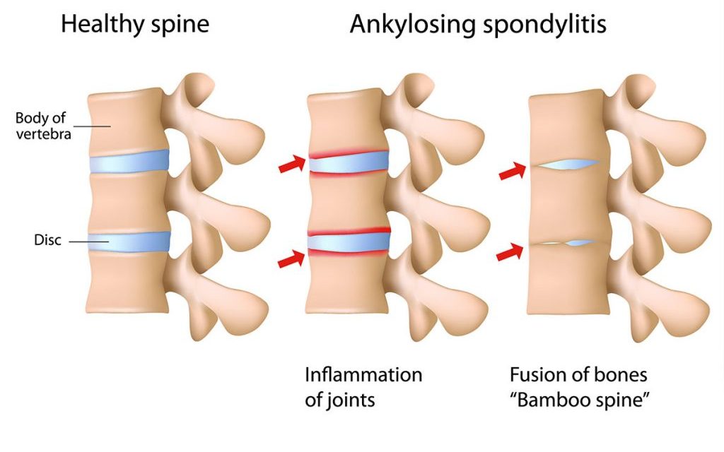 間充質(zhì)干細(xì)胞療法與強(qiáng)直性脊柱炎:一種新的治療方法 間充質(zhì)干細(xì)胞療法與強(qiáng)直性脊柱炎:一種新的治療方法