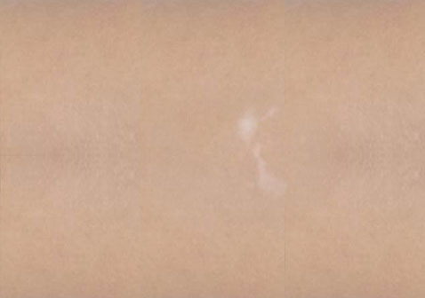 白癜風(fēng)白斑初期癥狀輕微小斑點(diǎn)，無(wú)色素。