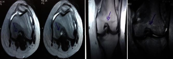 圖1：治療前MRI顯示內側和外側半月板后角的III級撕裂。