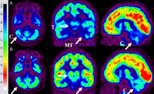 圖6:ASD患者在細胞治療前和細胞治療后6個月進行的FDG-PET/CT大腦掃描的代表性圖像。 圖6:ASD患者在細胞治療前和細胞治療后6個月進行的FDG-PET/CT大腦掃描的代表性圖像。