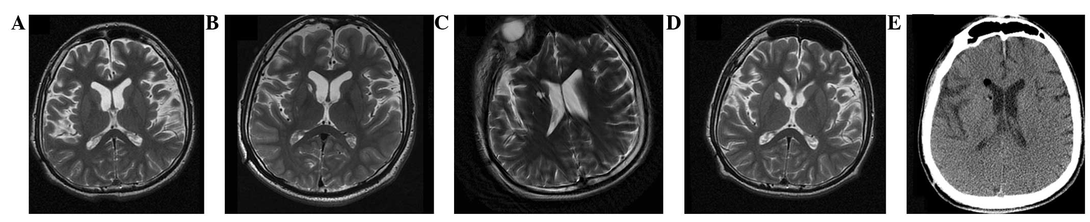 圖2:-T2加權磁共振成像 (MRI) 圖2:-T2加權磁共振成像 (MRI)
