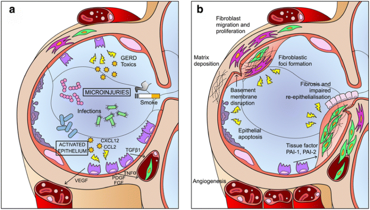 圖1：IPF發(fā)病機(jī)制示意圖