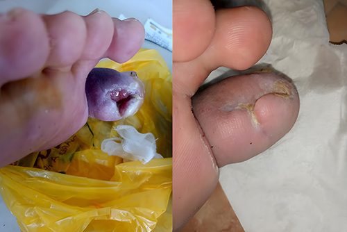 圖4：糖尿病潰瘍修復示例–干預前（左）和干預后（右）。