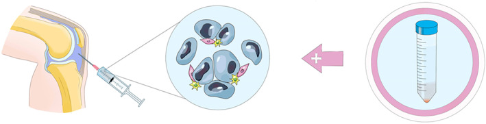 使用MSCs治療半月板損傷的流程 使用MSCs治療半月板損傷的流程
