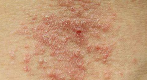 中重度濕疹 中重度濕疹