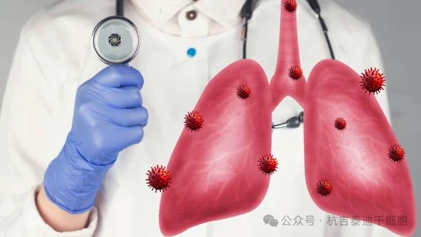 干細(xì)胞療法如何減緩肺部疾病的癥狀? 干細(xì)胞療法如何減緩肺部疾病的癥狀?