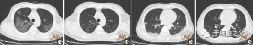 細(xì)胞輸注后,炎癥指標(biāo)改善,復(fù)查胸部CT提示雙肺病灶較前吸收,呼吸道癥狀改善,新型冠狀病毒核酸檢測(cè)連續(xù)2次陰性,治愈出院。 細(xì)胞輸注后,炎癥指標(biāo)改善,復(fù)查胸部CT提示雙肺病灶較前吸收,呼吸道癥狀改善,新型冠狀病毒核酸檢測(cè)連續(xù)2次陰性,治愈出院。