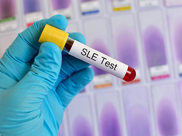 羊膜干細胞移植在系統性紅斑狼瘡中的應用前景 羊膜干細胞移植在系統性紅斑狼瘡中的應用前景