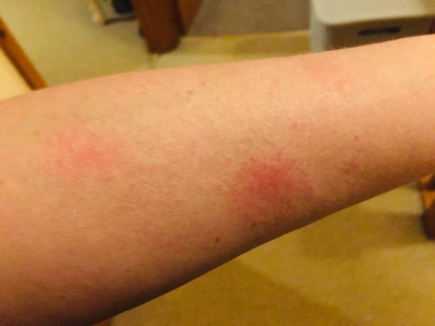 系統性紅斑狼瘡的最佳治療方法是什么? 系統性紅斑狼瘡的最佳治療方法是什么?