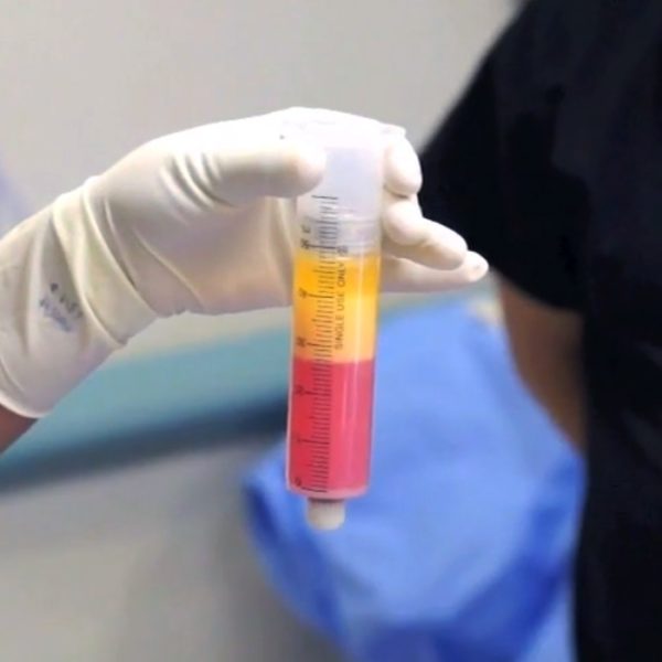 購(gòu)買(mǎi)和使用低溫保存(冷凍)的臍帶干細(xì)胞是許多干細(xì)胞治療提供者的另一種流行選擇。 購(gòu)買(mǎi)和使用低溫保存(冷凍)的臍帶干細(xì)胞是許多干細(xì)胞治療提供者的另一種流行選擇。