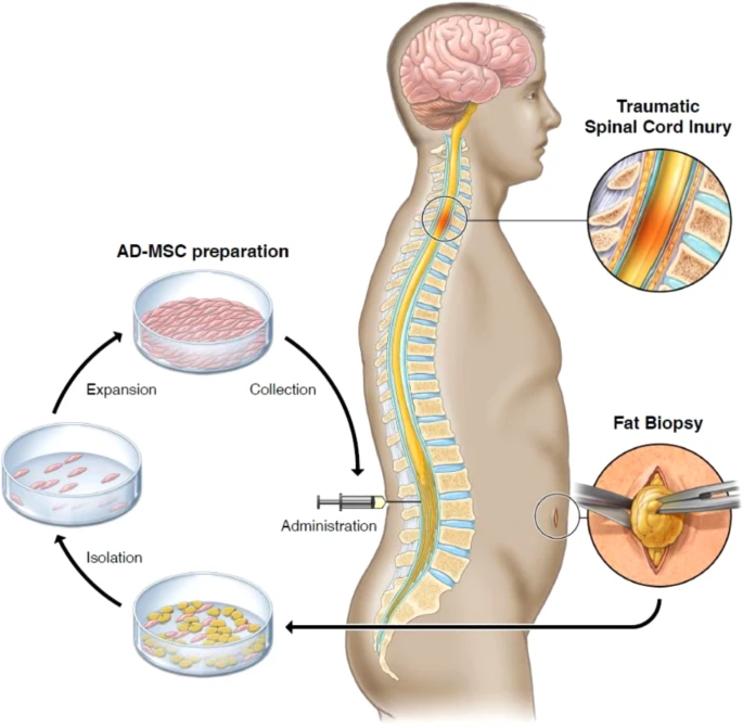 通過(guò)活檢、AD-MSC 分離、擴(kuò)增和收集以及治療管理來(lái)獲取脂肪的過(guò)程圖解 通過(guò)活檢、AD-MSC 分離、擴(kuò)增和收集以及治療管理來(lái)獲取脂肪的過(guò)程圖解