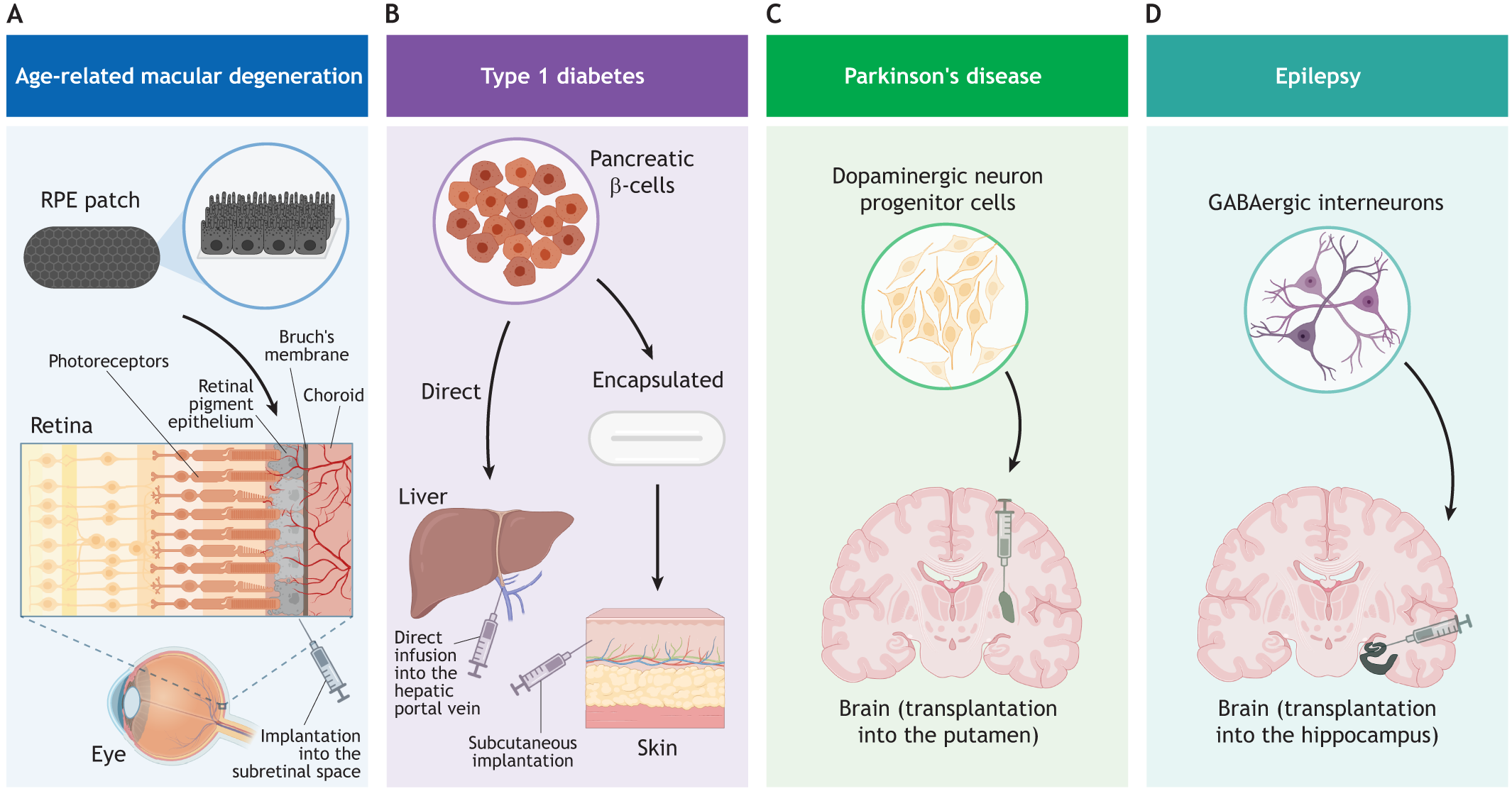 圖2:使用hPSC衍生細(xì)胞產(chǎn)品進(jìn)行開創(chuàng)性臨床試驗(yàn)時(shí)所涉及的細(xì)胞類型和注射部位的圖示。 圖2:使用hPSC衍生細(xì)胞產(chǎn)品進(jìn)行開創(chuàng)性臨床試驗(yàn)時(shí)所涉及的細(xì)胞類型和注射部位的圖示。