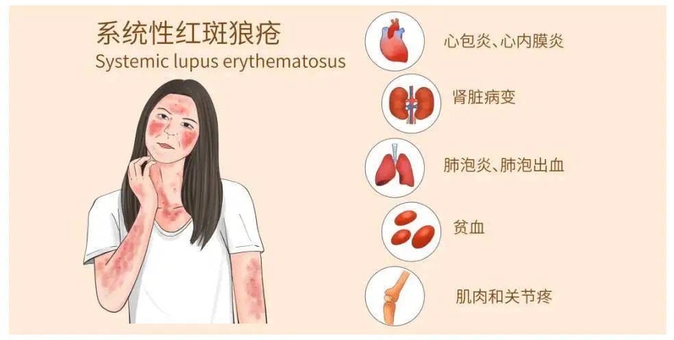 什么是系統性紅斑狼瘡？