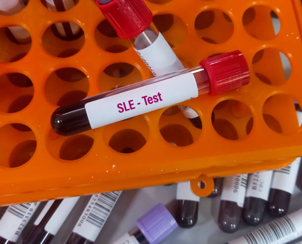 干細胞移植治療系統性紅斑狼瘡的臨床療效分析