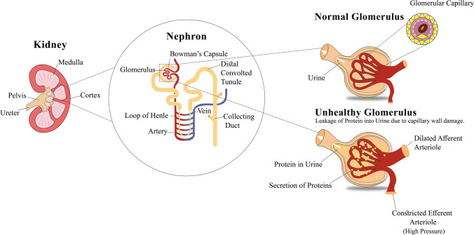 圖1：導(dǎo)致糖尿病腎病的原因，即糖尿病引起的腎臟疾病