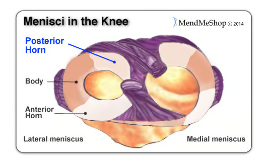 后角半月板撕裂癥狀、原因以及治療方法