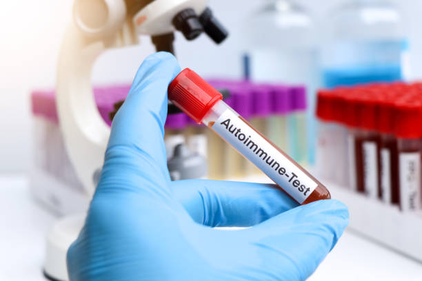 干細胞在類風濕關節炎、系統性紅斑狼瘡、銀屑病等自身免疫性疾病中的治療作用