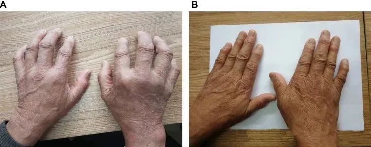 一名68歲男性被診斷患有類風濕性關節炎治療前后對比