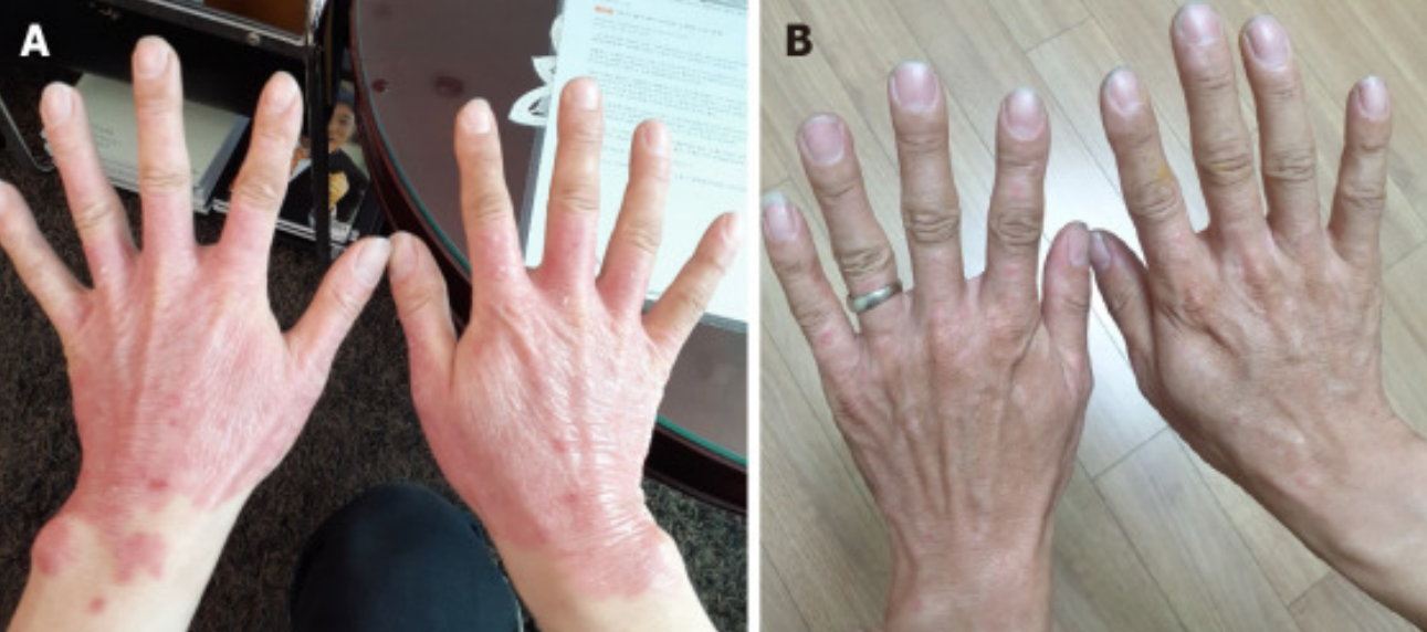 3次干細(xì)胞治療后25年?銀屑病頑疾得到顯著改善! 3次干細(xì)胞治療后25年?銀屑病頑疾得到顯著改善!