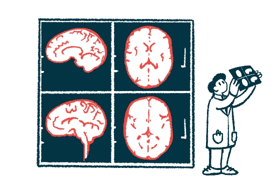 MRI精準給藥系統用于干細胞治療帕金森癥的臨床試驗