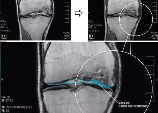 干細胞治療膝骨關節炎臨床案例