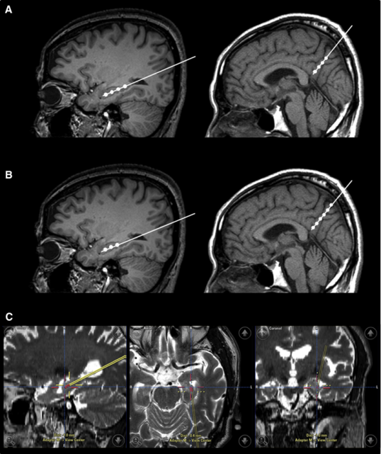 干細胞立體定向注射患者的右海馬體和右前丘盤 干細胞立體定向注射患者的右海馬體和右前丘盤